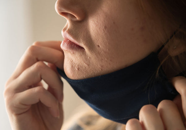 woman with acne irritation